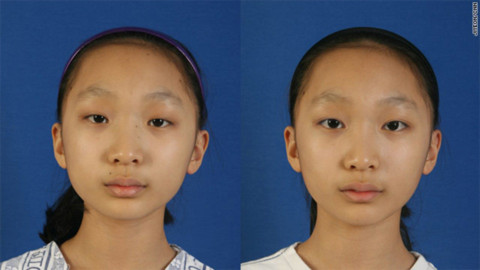 Lee Min-kyong trước và sau khi phẫu thuật cắt mí mắt. Ảnh: CNN.