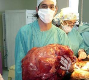 Phẫu thuật khối u tử cung nặng nhất thế giới