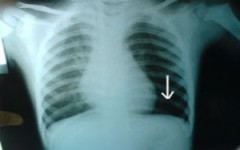 Cứu sống bé trai 30 tháng tuổi dính mảnh nilon ở phổi