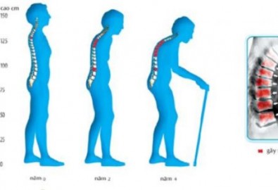 Giải pháp mới trong phòng ngừa và điều trị bệnh loãng xương