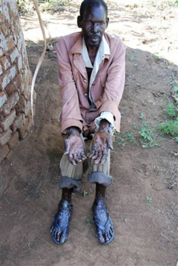 Anatoli Alemo, một người dân ở quận Kamuli, Uganda bị bọ hút máu xâm nhập vào tứ chi. Ảnh: AP.