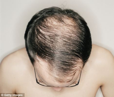 Tiêm hợp chất ACell và PRP có thể giúp phòng ngừa rụng thêm tóc và giúp khôi phục mái tóc của bệnh nhân. (Ảnh Daily Mail)