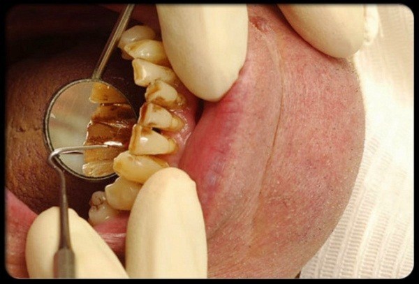 Hút thuốc lá: Từ lợi ích "ngỡ ngàng" tới tác hại khôn lường 4 Hút thuốc lá: Từ lợi ích "ngỡ ngàng" tới tác hại khôn lường 4