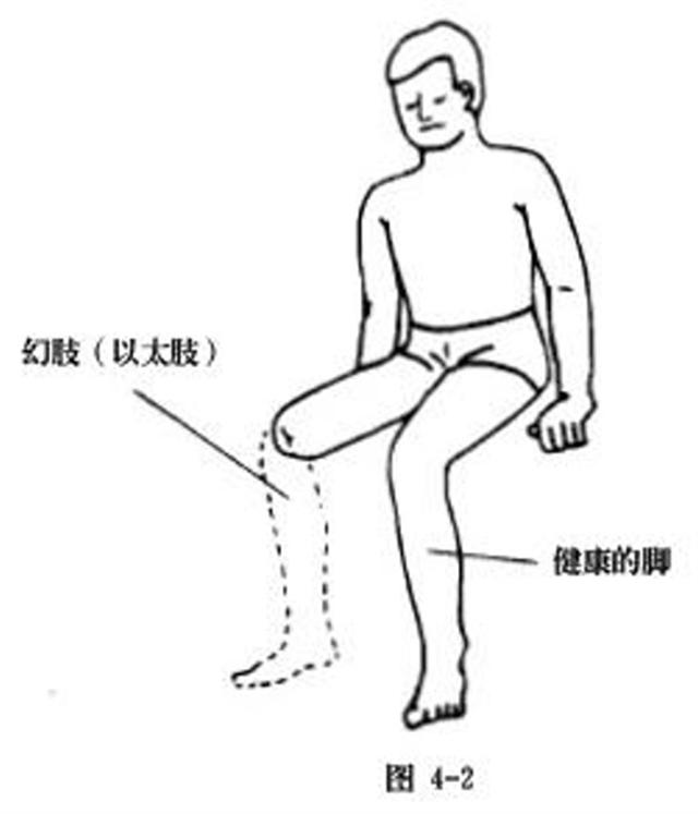 Sự đau nhức của “Hồn của chân (tay)” : Sau khi cắt cụt chân ( tay ), nhiều người vẫn còn cảm thấy đau đớn tại khu vực đó. (mạng Chánh Kiến)