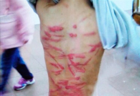 Cậu bé Xiao Bing bị mẹ đánh bầm dập khắp lưng vì tội không làm bài tập về nhà .