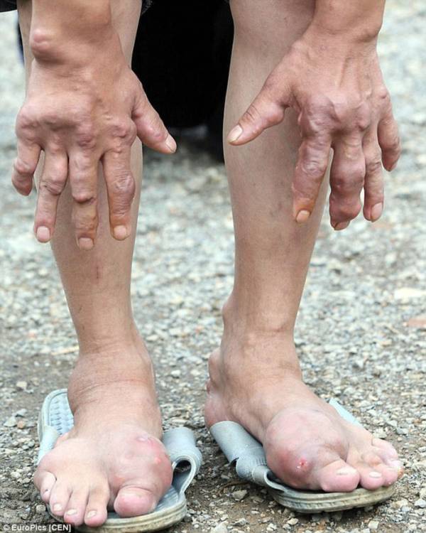 Bệnh lạ khiến người dân một ngôi làng bị xoắn xương tới biến dạng tay chân 2