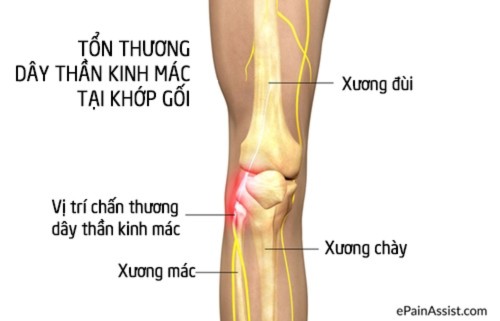 vắt chéo, có thể, chân tay, Bài chọn lọc, 