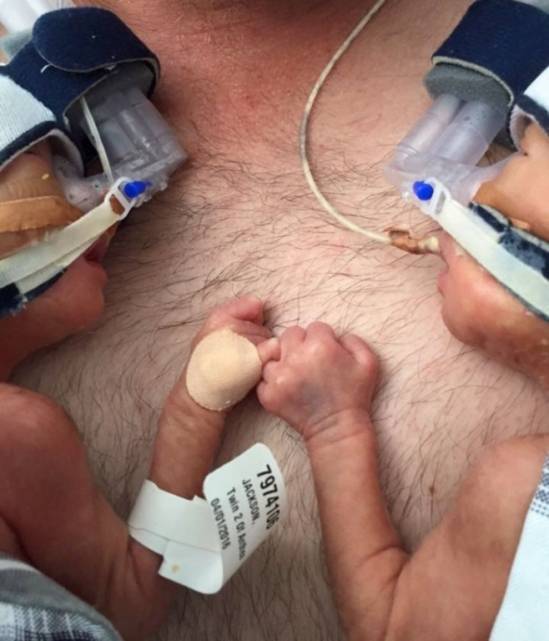 premature-birth-twins-hold-hands-babies-anthea-jackson-rushford-4