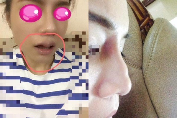 Những bạn trẻ đã và đang rước họa vào thân vì ham phẫu thuật thẩm mỹ - Ảnh 12. Những bạn trẻ đã và đang rước họa vào thân vì ham phẫu thuật thẩm mỹ - Ảnh 12.