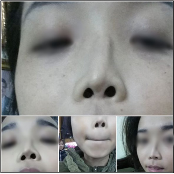Những bạn trẻ đã và đang rước họa vào thân vì ham phẫu thuật thẩm mỹ - Ảnh 5. Những bạn trẻ đã và đang rước họa vào thân vì ham phẫu thuật thẩm mỹ - Ảnh 5.