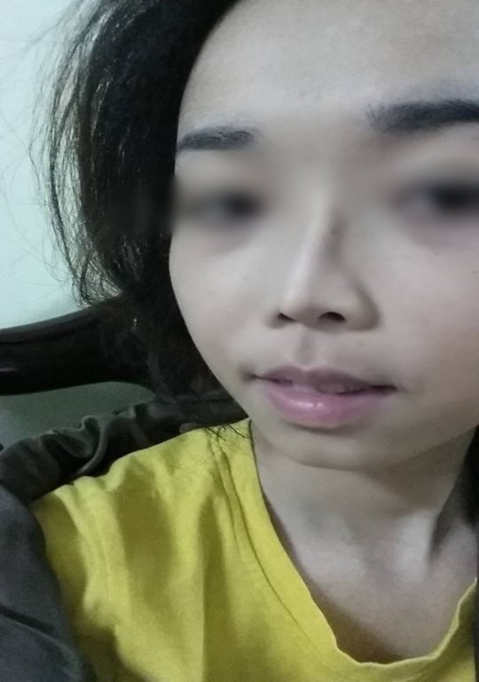 Những bạn trẻ đã và đang rước họa vào thân vì ham phẫu thuật thẩm mỹ - Ảnh 6. Những bạn trẻ đã và đang rước họa vào thân vì ham phẫu thuật thẩm mỹ - Ảnh 6.