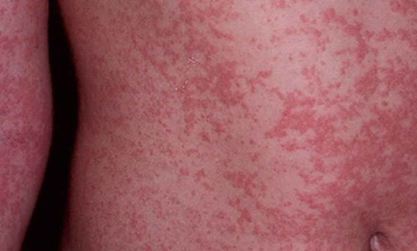 Dịch Zika xuất hiện ở Việt Nam: Dấu hiệu bệnh và cách phòng tránh - Ảnh 1. Dịch Zika xuất hiện ở Việt Nam: Dấu hiệu bệnh và cách phòng tránh - Ảnh 1.