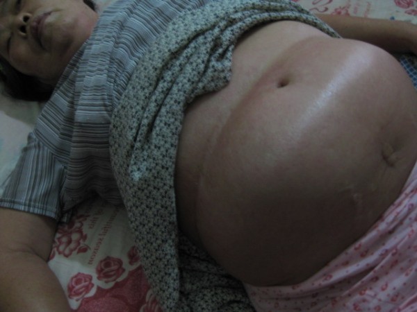 Bụng học viên Lưu Hiểu Liên to như người mang thai (Ảnh: mạng Minh Huệ).