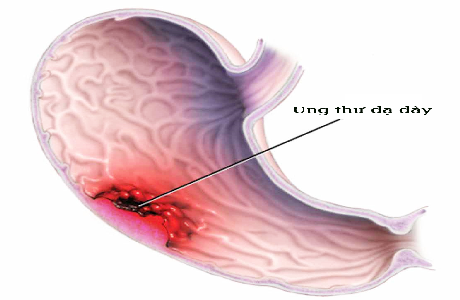 ung thư dạ dày