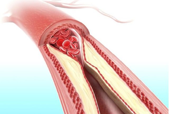 Động mạch bị chặn hoặc tắc nghẽn thường xảy ra khi có mảng bám tích tụ trên thành động mạch và làm giảm đáng kể lượng máu lưu thông trong cơ thể. (Ảnh: benhtimmach.info.vn)