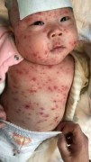 Một trẻ nhỏ xuất hiện phản ứng sau khi dùng vắc-xin quá hạn (Ảnh phụ huynh cung cấp cho theepochtimes.com)