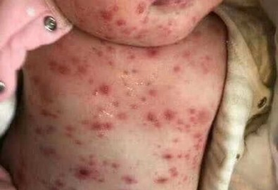 Một trẻ nhỏ xuất hiện phản ứng sau khi dùng vắc-xin quá hạn (Ảnh phụ huynh cung cấp cho theepochtimes.com)